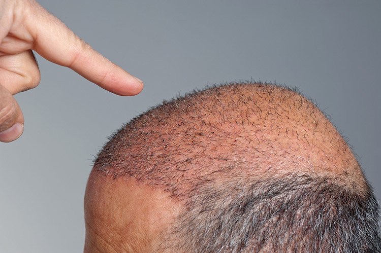 Hair Transplantation: A Growing Market Placing Brazil on the Global Map of Aesthetic Innovation